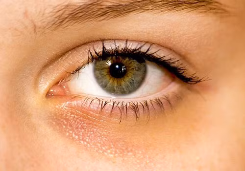 Quầng thâm dưới mắt: Nếu bạn không ngủ đủ giấc, quầng thâm dưới mắt sẽ xuất hiện. Theo Medical News Today, các bác sĩ khuyên mỗi đêm bạn nên ngủ không ít hơn 7-8 giờ. Tuy nhiên, quầng thâm dưới mắt cũng là dấu hiệu của bệnh thiếu máu. Khi đó, cơ thể không sản xuất đủ tế bào hồng cầu, vùng da dưới mắt sẽ bị thâm quầng.