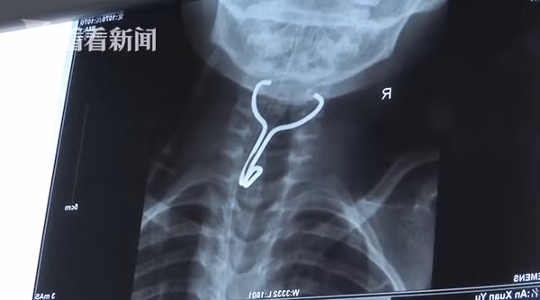 Con trai 6 tuổi hô hấp khó khăn, cổ họng sưng tấy đầy mủ, bố mẹ đưa đi nhập viện liền giật mình kinh hãi trước thứ bác sĩ gắp từ trong cổ họng con ra - Ảnh 2.