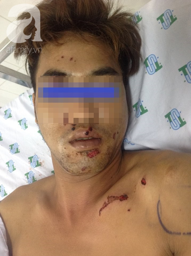 Tai nạn nguy hiểm: Vừa sạc pin vừa nói chuyện điện thoại, thanh niên 29 tuổi suýt nát mặt, mất bàn tay - Ảnh 1.