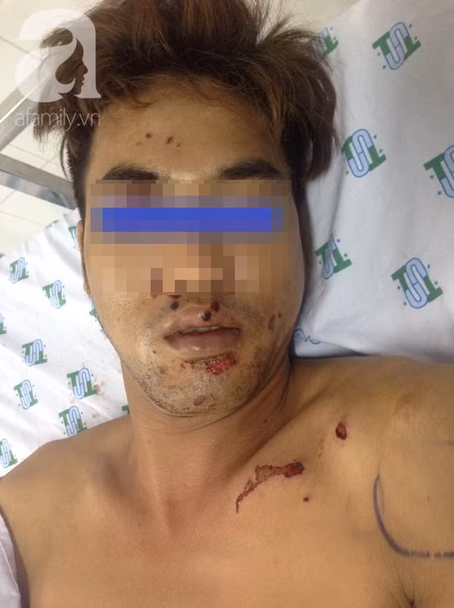 Tai nạn nguy hiểm: Vừa sạc pin vừa nói chuyện điện thoại, thanh niên 29 tuổi suýt nát mặt, mất bàn tay - Ảnh 1. Tai nạn nguy hiểm: Vừa sạc pin vừa nói chuyện điện thoại, thanh niên 29 tuổi suýt nát mặt, mất bàn tay - Ảnh 1.