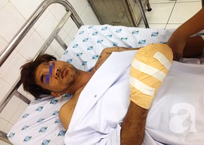 Tai nạn nguy hiểm: Vừa sạc pin vừa nói chuyện điện thoại, thanh niên 29 tuổi suýt nát mặt, mất bàn tay - Ảnh 2. Tai nạn nguy hiểm: Vừa sạc pin vừa nói chuyện điện thoại, thanh niên 29 tuổi suýt nát mặt, mất bàn tay - Ảnh 2.