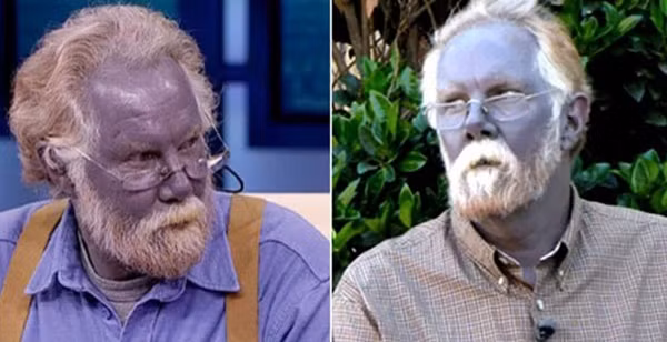 Top 10 căn bệnh kỳ lạ và đáng sợ nhất trên thế giới, y học chưa có lời giải-4