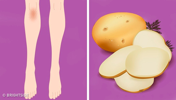 Khoai tây Khoai tây chứa rất nhiều enzyme catecholase, có công dụng hữu hiệu trong việc cải thiện sắc tố da. Bạn chỉ cần gọt vỏ, ép khoai tây lấy nước. Dùng nước ép này thoa lên khuỷu tay hoặc đầu gối, để khoảng 15 phút rồi rửa sạch với nước và thoa kem dưỡng ẩm.