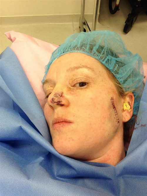 Lisa sau phẫu thuật ung thư da trên mặt. Ảnh: NVCC.