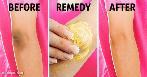 Nghệ Nghệ giúp loại bỏ tế bào da chết, thúc đẩy quá trình sản sinh tế bào da mới, giúp làm trắng da hiệu quả. Trộn 1 thìa bột nghệ với một chút sữa tươi tạo thành hỗn hợp sền sệt rồi thoa lên khuỷu tay/đầu gối. Để khoảng 20 phút rồi rửa sạch lại với nước.