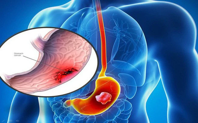 Cô gái bị ung thư dạ dày giai đoạn cuối bởi thói quen xấu nhiều bạn trẻ đang mắc phải