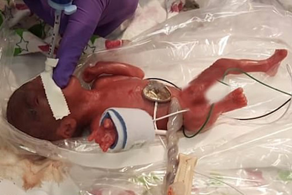 Bé gái tí hon chỉ bằng quả táo, đặt gọn trong bàn tay bác sĩ Bé gái tí hon chỉ bằng quả táo, đặt gọn trong bàn tay bác sĩ