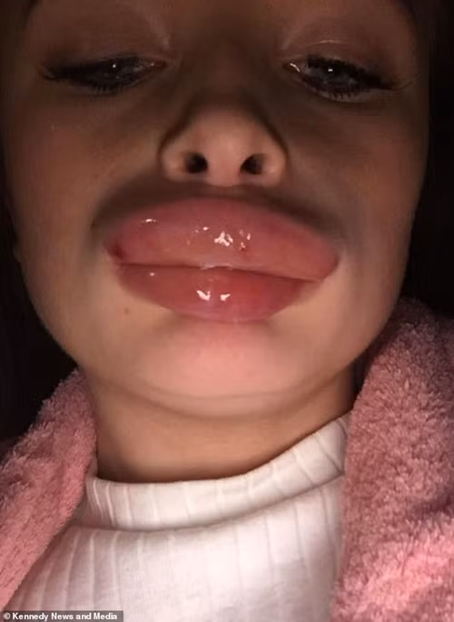 suyt mat mang vi ham bom moi gia re hinh anh 2