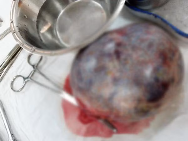 U nang buồn trứng của thai phụ 17 tuổi