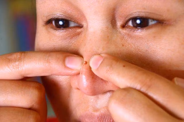 dua tre 10 tuoi phai phau thuat nao, chi vi me nan mun dau den o mui - 2