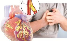 Dấu hiệu sớm cảnh báo bệnh động mạch vành