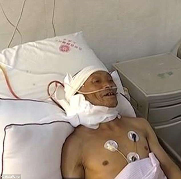 Ông Zhao đang hồi phục sau khiđược cắt bỏ khối u nặng khoảng 15kg. Ông Zhao đang hồi phục sau khiđược cắt bỏ khối u nặng khoảng 15kg.