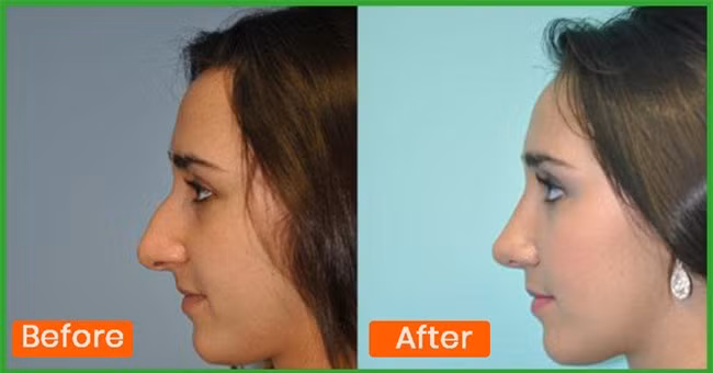 Những bài tập giúp mũi thon gọn không cần phẫu thuật thẩm mỹ - Ảnh 3.