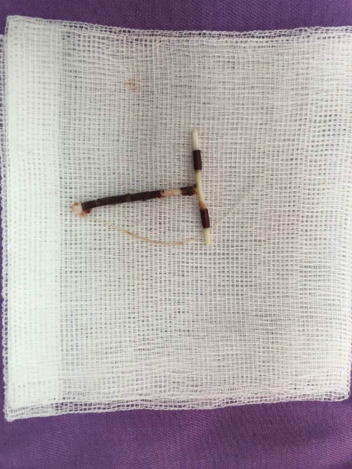 Vòng tránh thai được lấy ra khỏi bụng bệnh nhân.Ảnh bệnh viện cung cấp Vòng tránh thai được lấy ra khỏi bụng bệnh nhân. Ảnh: B.V