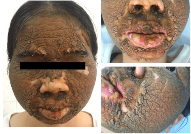 Tình trạng bệnh nhân khi đến khám tại Bệnh viện Da liễu Trung ương tháng 6/2019. Ảnh: BVCC