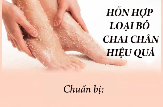 Loại bỏ hoàn toàn chai chân với hỗn hợp bốn thành phần tự chế