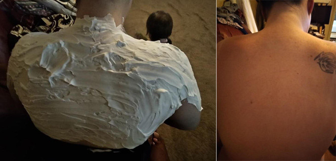 Cindie thấy dễ chịu hơn sau khi bôi kem cạo râu lên vùng da cháy nắng. Cindie thấy dễ chịu hơn sau khi bôi kem cạo râu lên vùng da cháy nắng.