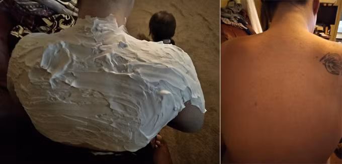 Cindie thấy dễ chịu hơn sau khi bôi kem cạo râu lên vùng da cháy nắng. Cindie thấy dễ chịu hơn sau khi bôi kem cạo râu lên vùng da cháy nắng.