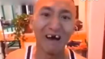 Chàng trai mất hết răng cửa vì tham gia thử thách ăn ngô bằng máy khoan