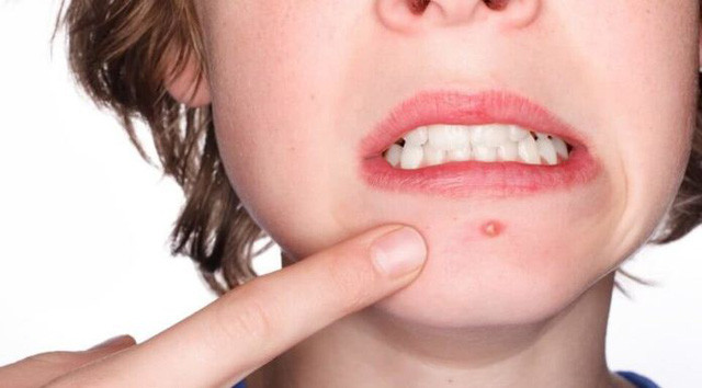 Tác dụng chữa bệnh tuyệt vời của đu đủ xanh không phải ai cũng biết ảnh 2 Thoa nước đu đủ xanh để những chiếc mụn nhọt không tàn phá da bạn nữa. Hình minh họa