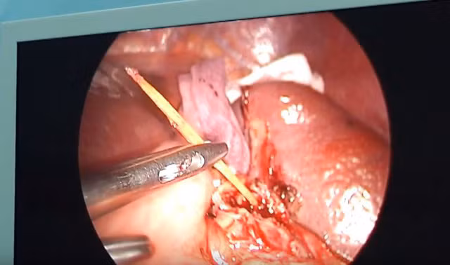 Cây tăm được lấy ra khỏi lá lách - Ảnh: BVCC