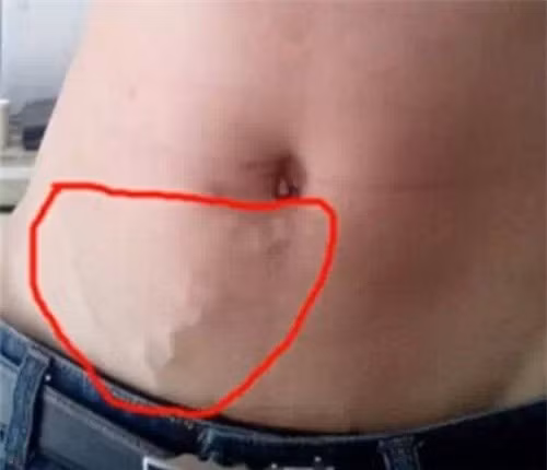 Phụ nữ chớ nên coi thường việc nổi gân xanh trên cơ thể, nhất là trên chân - Ảnh 3. Phụ nữ chớ nên coi thường việc nổi gân xanh trên cơ thể, nhất là trên chân - Ảnh 3.