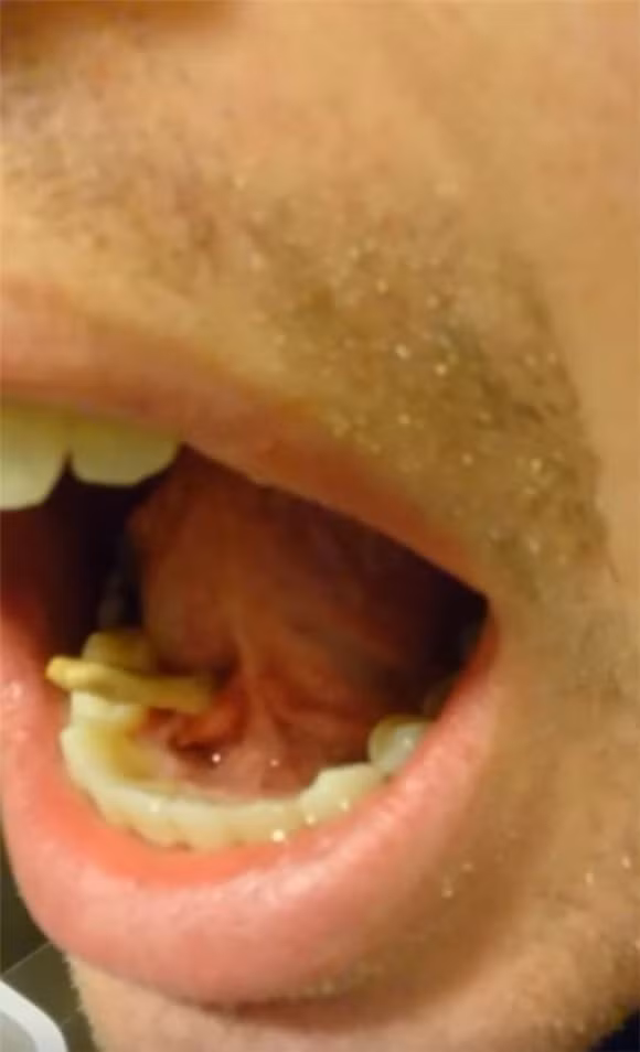 vật thể lạ trong miệng, lấy sỏi trong miệng, sỏi nước bọt