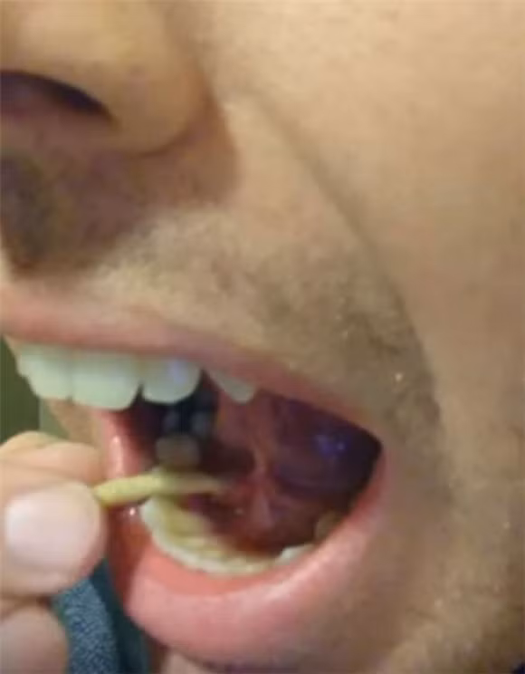 vật thể lạ trong miệng, lấy sỏi trong miệng, sỏi nước bọt