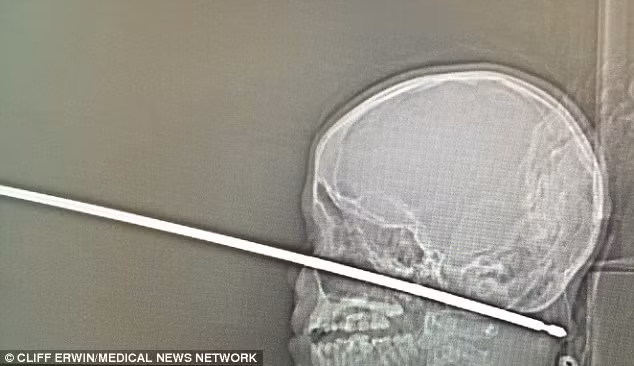 Thanh sắt xuyên thủng sọ, bé trai 10 tuổi sống sót kỳ diệu