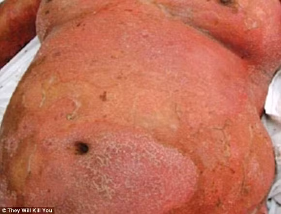 10 căn bệnh đáng sợ nhất trên thế giới 5