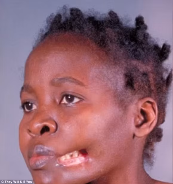 10 căn bệnh đáng sợ nhất trên thế giới 3