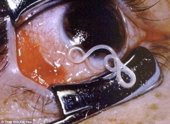 10 căn bệnh đáng sợ nhất trên thế giới 9