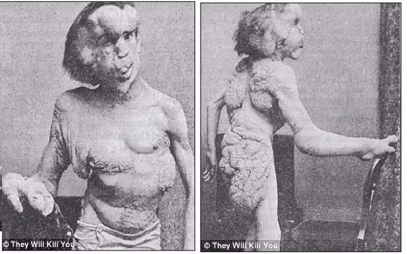 10 căn bệnh đáng sợ nhất trên thế giới 11