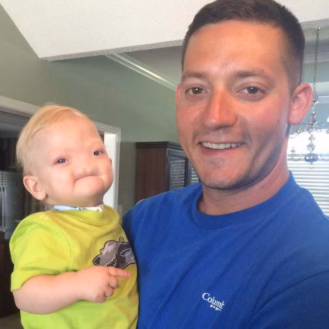 Ca sinh nở hiếm gặp: Em bé chào đời hoàn toàn không có mũi khiến bác sĩ cũng kinh ngạc vì chưa gặp bao giờ - Ảnh 3.