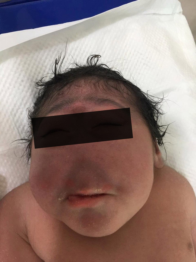 Ca sinh nở hiếm gặp: Em bé chào đời hoàn toàn không có mũi khiến bác sĩ cũng kinh ngạc vì chưa gặp bao giờ - Ảnh 1. Ca sinh nở hiếm gặp: Em bé chào đời hoàn toàn không có mũi khiến bác sĩ cũng kinh ngạc vì chưa gặp bao giờ - Ảnh 1.