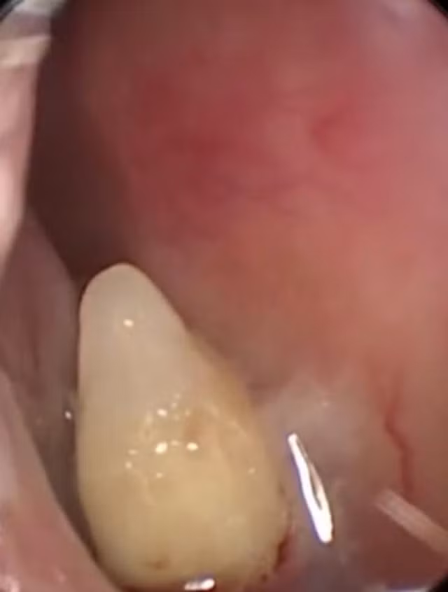 Chiếc răng đã thành hình đầy đủ trong mũi cô Xia