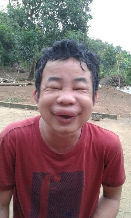 Săm môi thành công