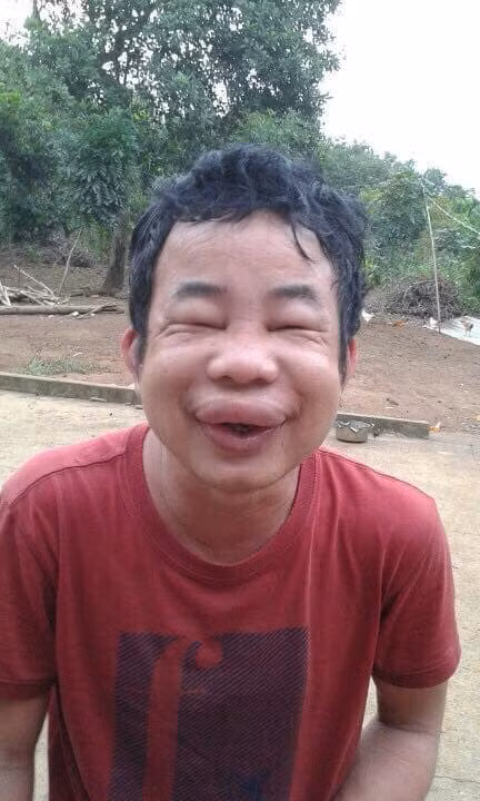 Săm môi thành công