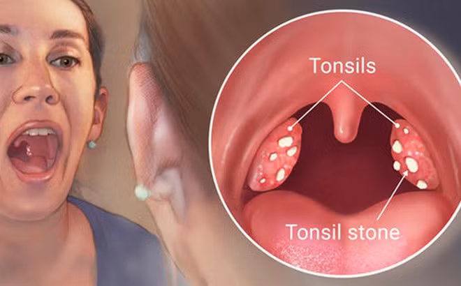 Viêm họng mãn tính là một trong những căn bệnh phổ biến.