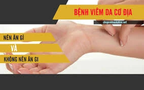 Trẻ 3 tuổi bị viêm da cơ địa có phải kiêng ăn hải sản?