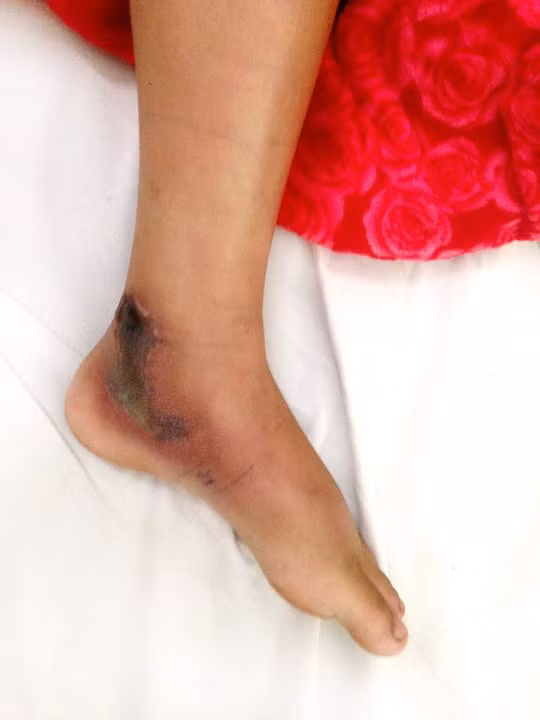 Đồng Nai: Bé gái 11 tuổi bị rắn hổ mèo tấn công - Ảnh 1.