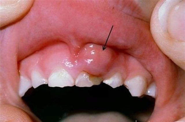 Cậu bé 9 tuổi có 70 chiếc răng: Nha sĩ cảnh báo điều gì? ảnh 1 cau be 9 tuoi co 70 chiec rang, bs nhac neu rang tre mai khong moc nen kham ngay - 1