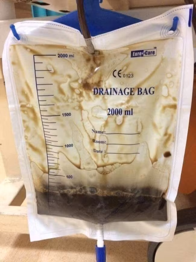 Đây là chất lỏng đen như hắc ín được lấy ra từ phổi của một người hút thuốc bị ung thư phổi giai đoạn cuối. Xin hãy ngừng hút thuốc lá trước khi quá muộn!