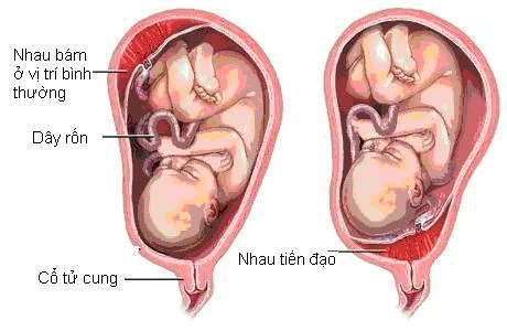 Mẹ bất ngờ tử vong sau khi vừa sinh đôi chỉ vì nguyên nhân không thể ngờ