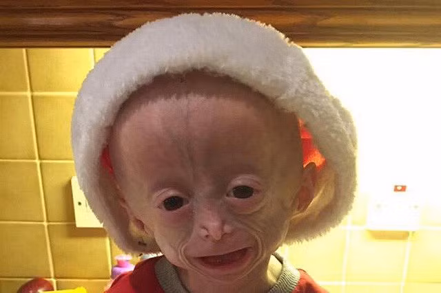 Trong 4 triệu ca mới có 1 trường hợp già sớm như em bé 8 tuổi nhưng mang hình hài của bà cụ 70 tuổi. - Hình 2