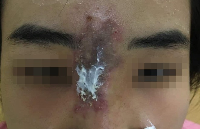 Nữ sinh 19 tuổi bị hoại tử da sau nâng mũi ảnh 1 Cô gái bị nhiễm trùng hoại tử da vùng mũi sau khi tiêm chất làm đầy. Ảnh bác sĩ cung cấp.