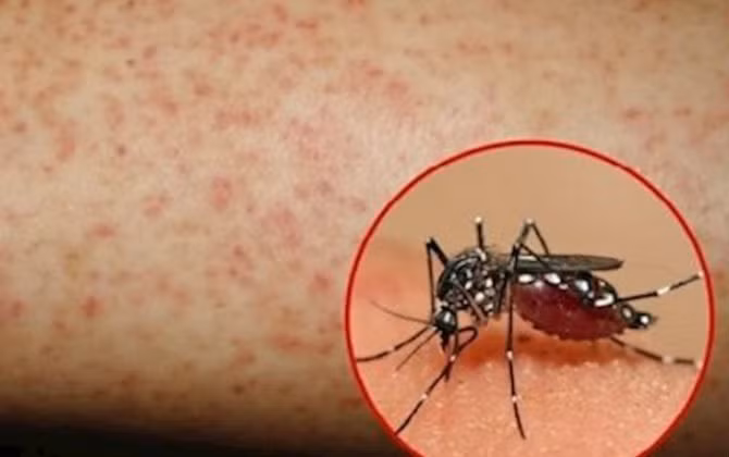 Sốt xuất huyết lây truyền chủ yếu do muỗi Aedes Aegypti.