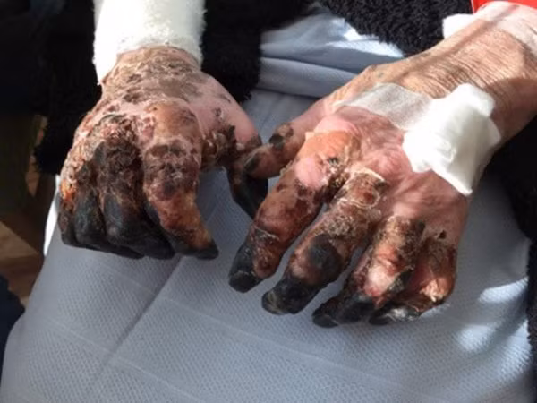 Sau cái liếm yêu” của chó cưng, người đàn ông 48 tuổi nhiễm khuẩn lạ, phải cắt bỏ môi, mũi, tứ chi-4