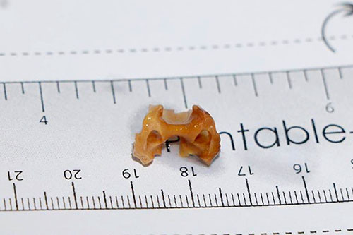 Mảnh xương gà sau khi được gắp ra. Mảnh xương gà sau khi được gắp ra. Ảnh: Đ.H