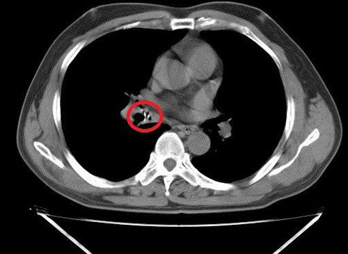 Dị vật nằm trong phế quản của cụ ông khi nội soi. Dị vật nằm trong phế quản của cụ ông khi nội soi. Ảnh: Đ.H